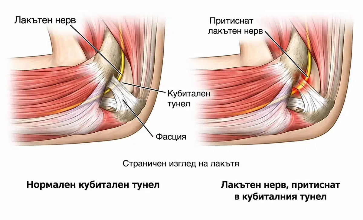 Медицинска илюстрация на лакътя, сравняваща нормален кубитален тунел с притиснат лакътен нерв.
